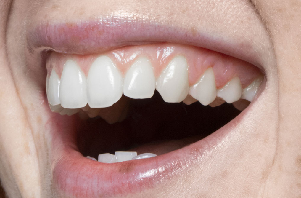 SONRISA DIENTES DESGASTADOS