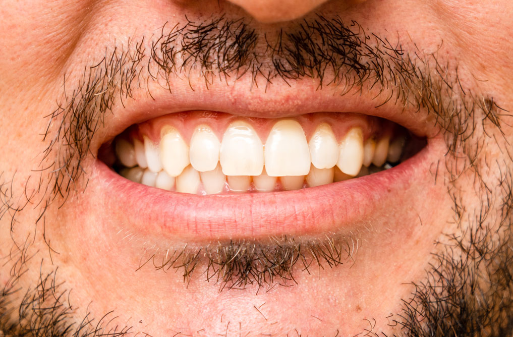 SONRISA DIENTES HOMBRE