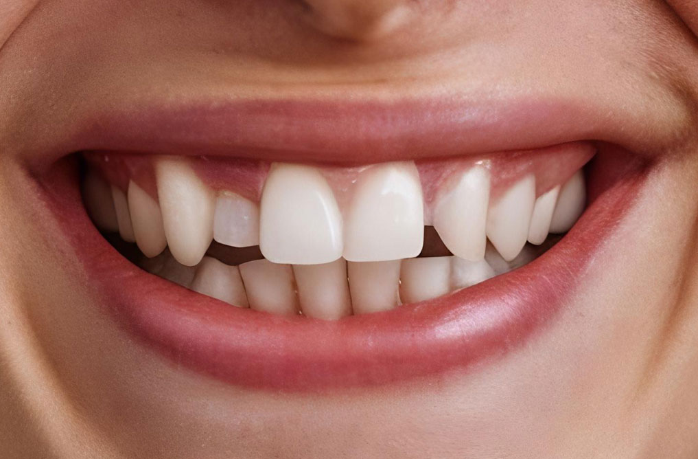 SONRISA DIENTES MAL