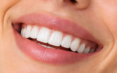 Carillas dentales: tipos, precio, ventajas y resultados